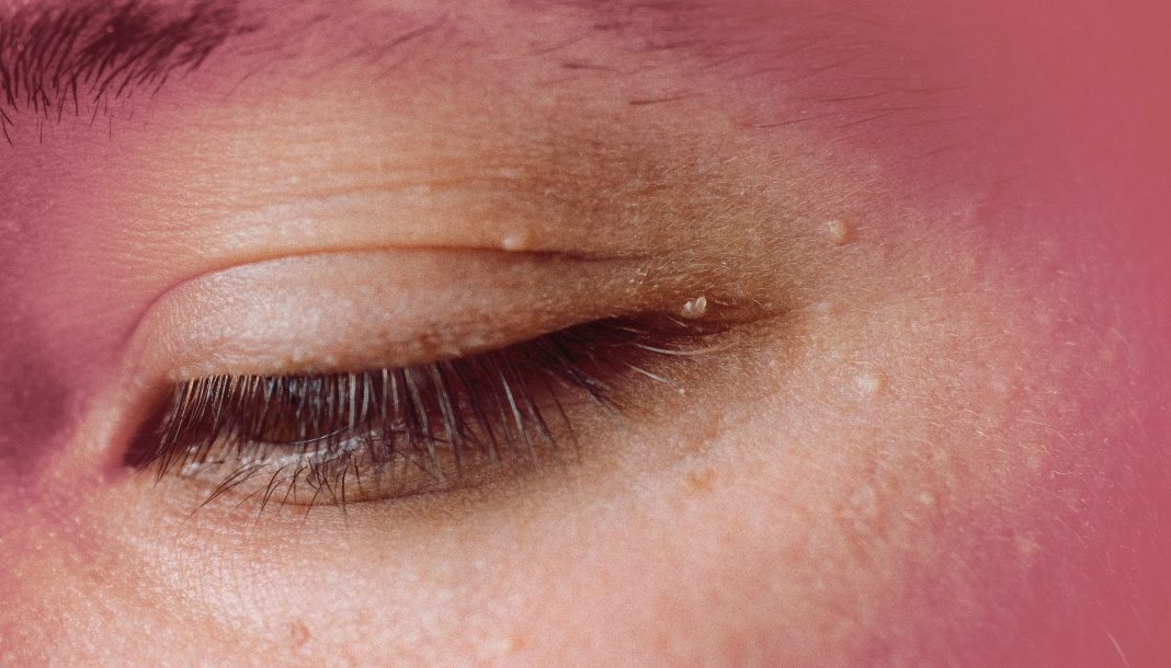 6-types-of-eyelid-bumps-and-how-to-treat-them,-according-to-dermatologists